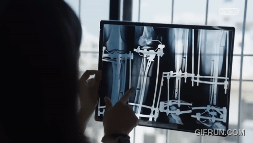 Breaking Bones to Grow Taller in India