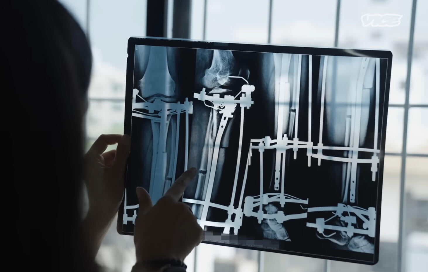 An X-Ray view of the patient's leg with the attached limb-lengthening apparatus
